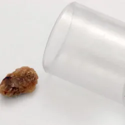 kidney_stone_v_gallstones_pic