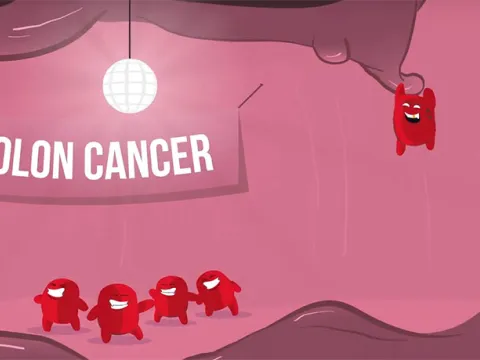 Colon Cancer video Thumbnail